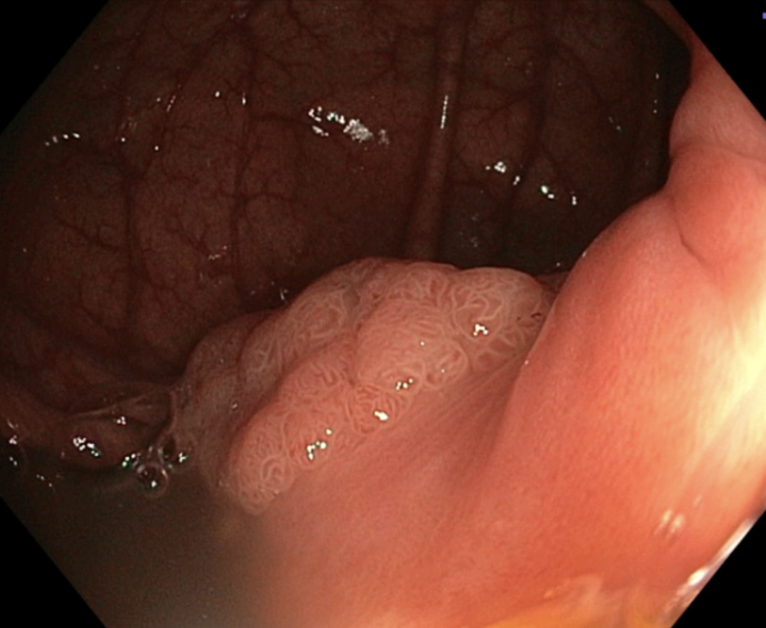 Mis-on-polüüp-Seirekliinik